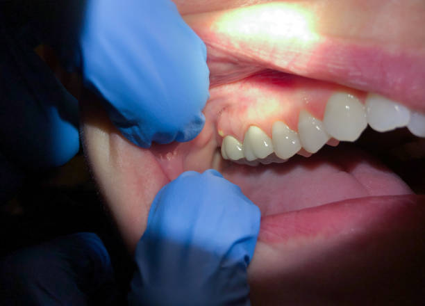 Best Lost Filling or Crown Replacement in Hartsdale, NY